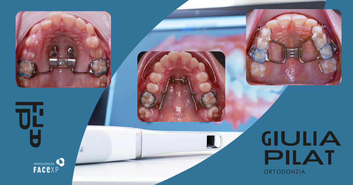 DT News - Aly - Trattamento Endodontico Ortogrado Con Strumenti Trattati Termicamente - Foto 8